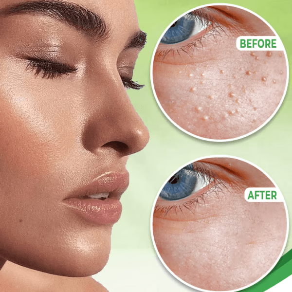 Crema para eliminar milia ocular