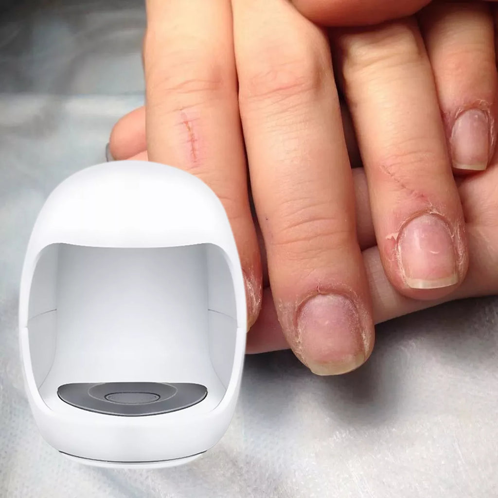 Dispositivo de clip para tratamiento láser de hongos en las uñas de los pies